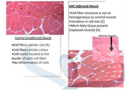 Image shows an unaffected muscle under a microscope compared to a GNE affected muscle. The affected muscle shows more variation in cell size, the cell fibre structure is not as homogenous as the control muscle and more fatty tissue is present.