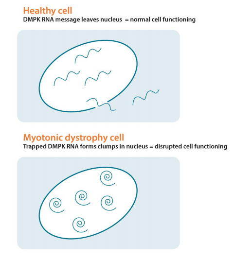 Image showing a healthy cell with DMPK messages leaving nucleus compared to a myotonic dystrophy cell where the trapped DMPK RNA forms clumps in the nucleus