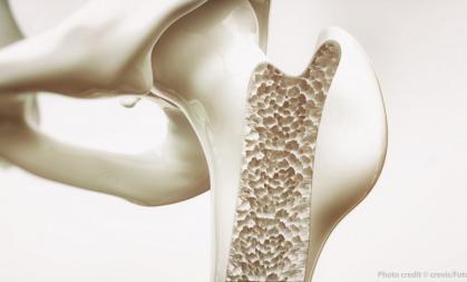Bone osteoporosis 